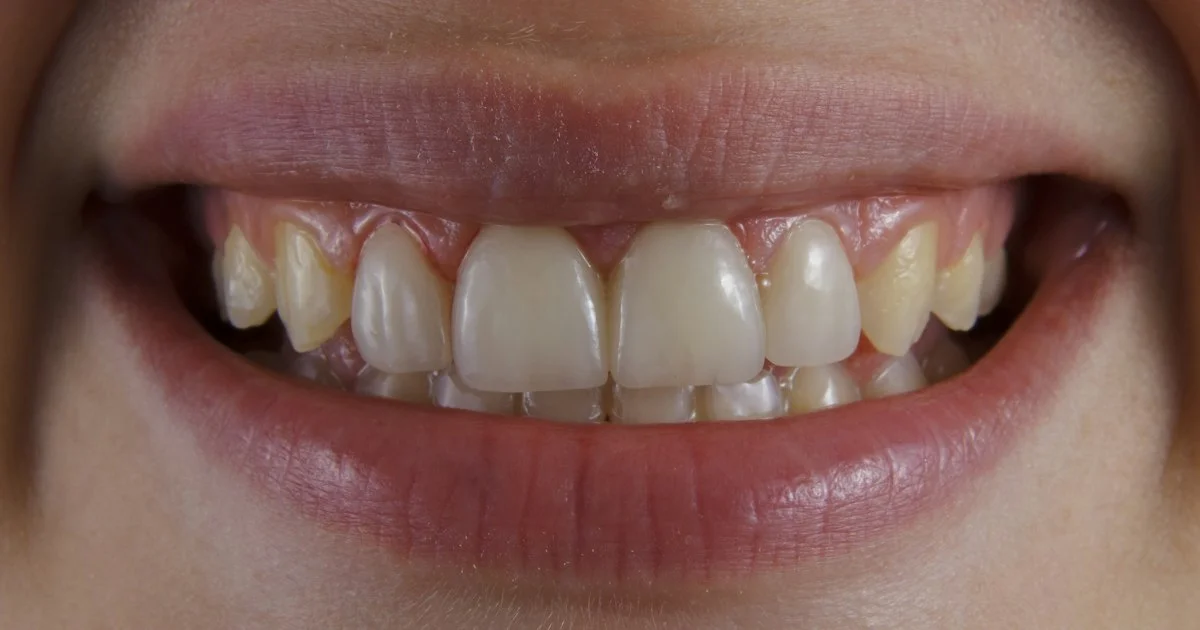 A close-up of a natural smile in which the canines sit visibly darker than the front incisors, the uneven starting point behind any best teeth whitening kit 2026 choice
